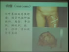 肿瘤学概论视频教程 32讲 复旦大学 精品课程